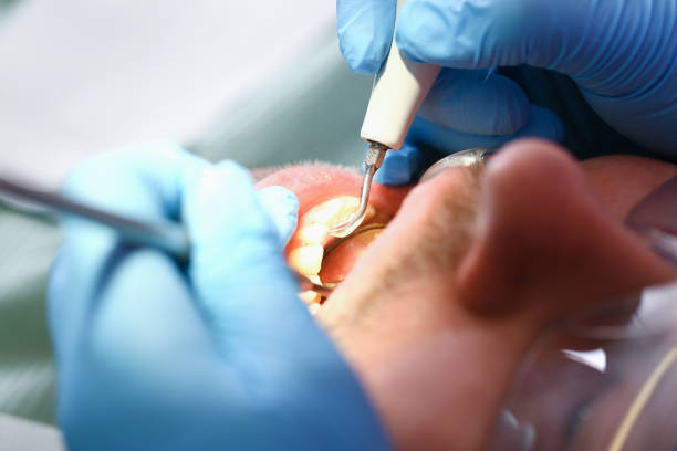 Best Dentist for Tooth Abscess  in Cisco, TX