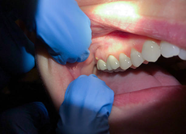Best Urgent Tooth Repair  in Cisco, TX